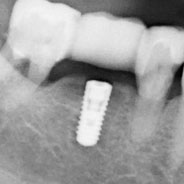 Implantologie, Zahnarztpraxis Othmarschen